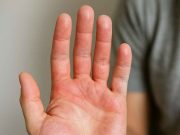 Symptoms of Type 1 Diabetes That Patients Often Miss Hand showing redness and dryness, early symptom of undiagnosed Type 1 Diabetes