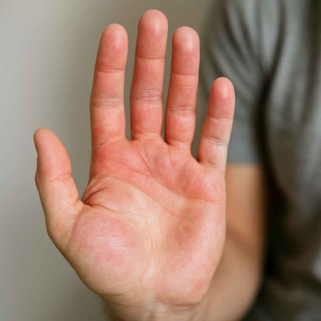 Hand showing redness and dryness, early symptom of undiagnosed Type 1 Diabetes