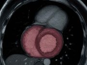 New Research: Diabetes Changes the Shape of Your Heart